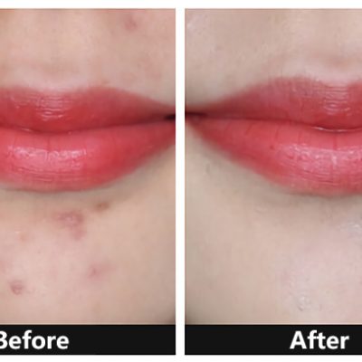 before use concealer & after use concealer